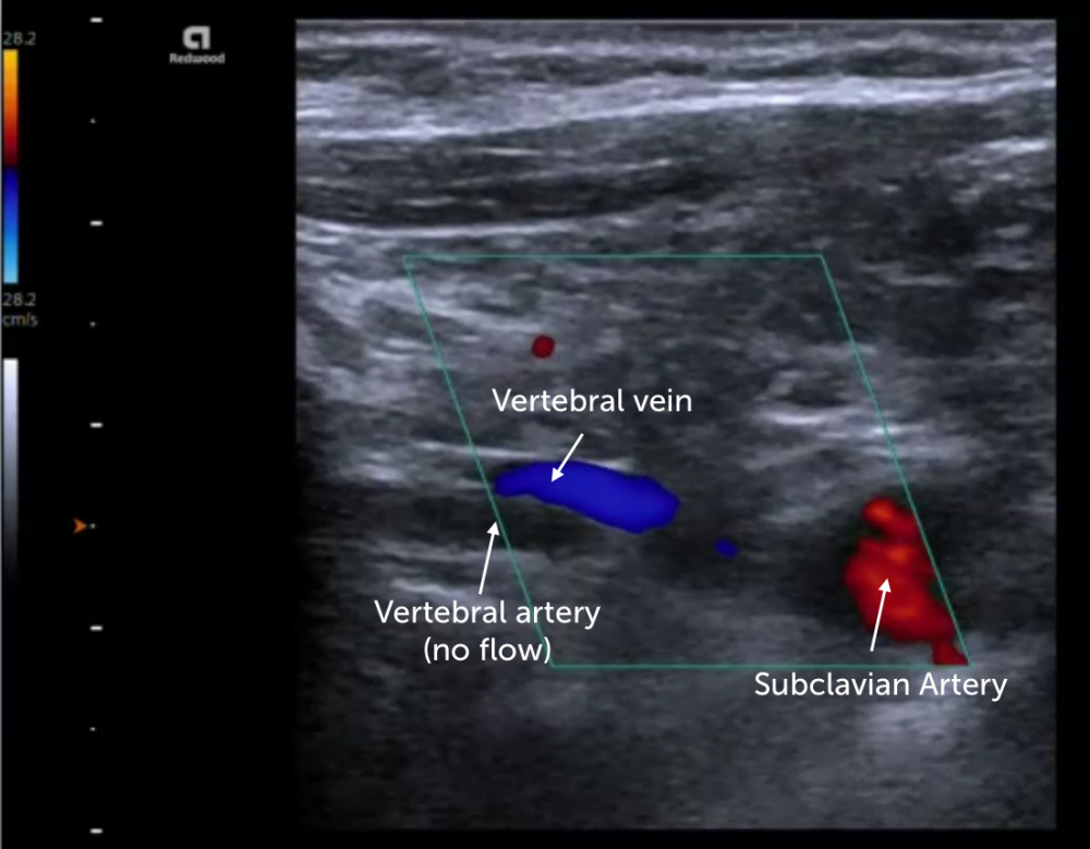 13 Vertebral Artery Pathologies 123 Sonography 